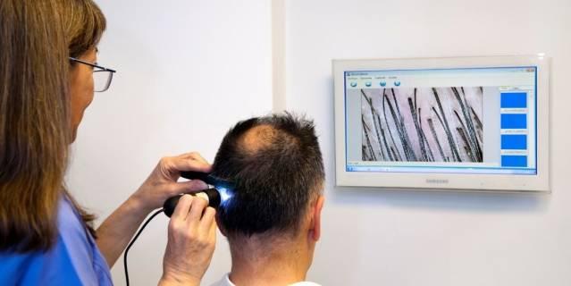 Se triplican los trasplantes capilares en España