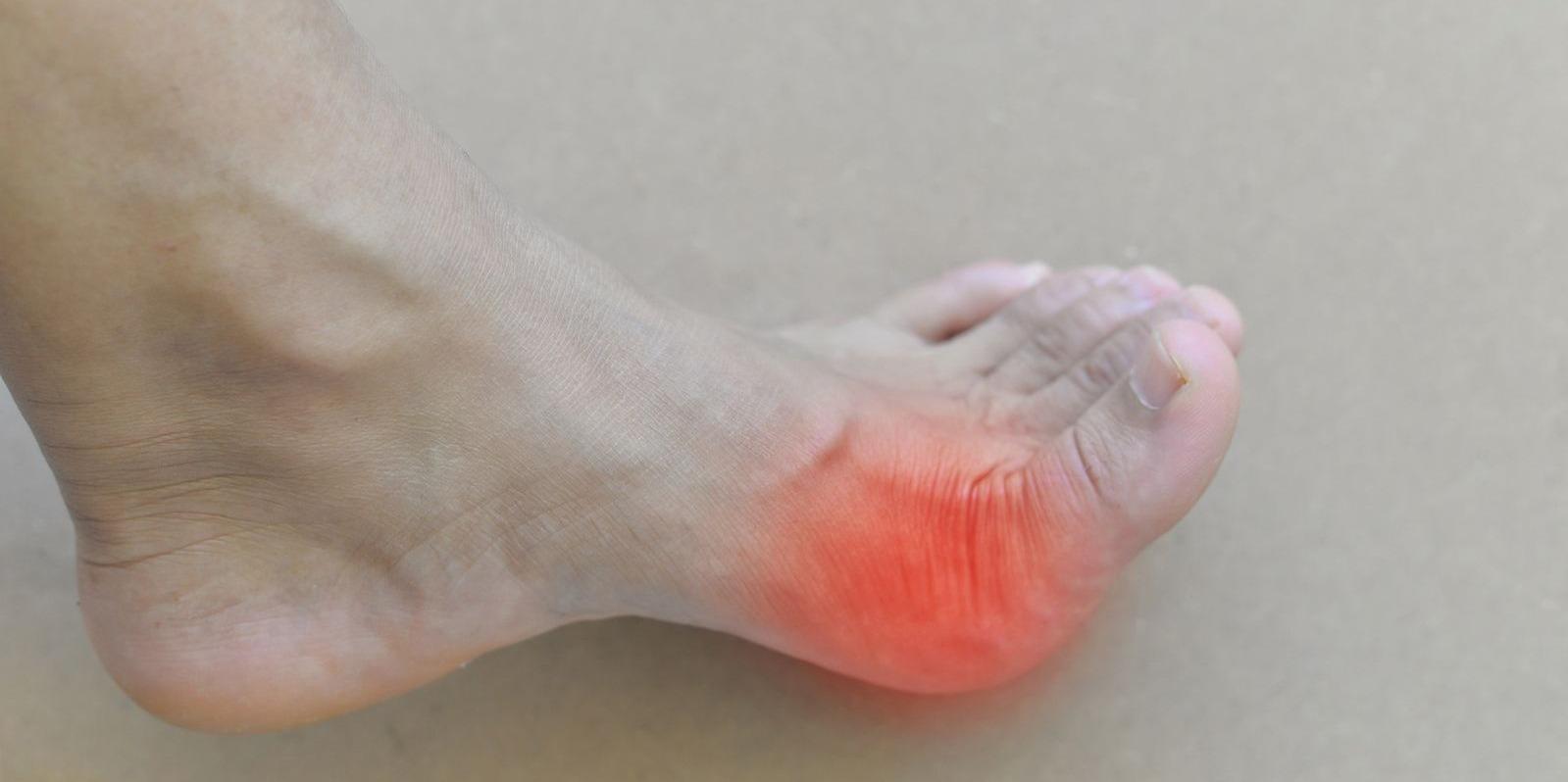 Los pacientes con gota sin un tratamiento adecuado tienen mayor mortalidad cardiovascular y enfermedad renal avanzada