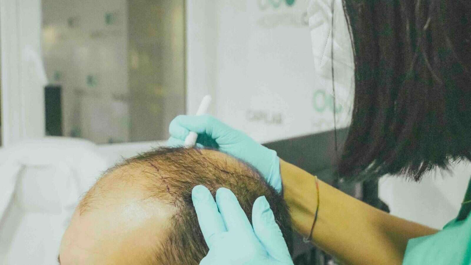 Cómo cuidar el pelo tras un injerto capilar: todo lo que debes tener en cuenta