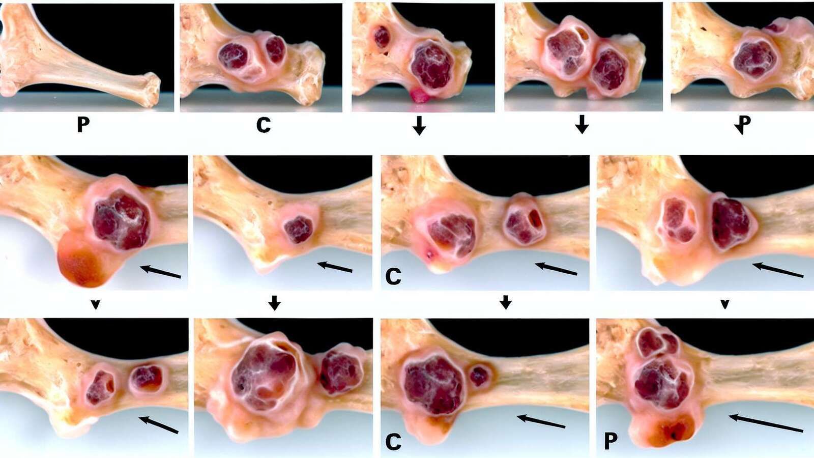 Nuevo biomarcador para el pronóstico del osteosarcoma