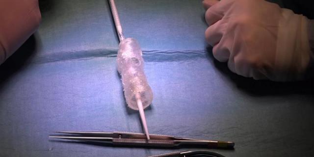 El Marañón salva a un paciente con la aorta rota gracias a la impresión 3D
