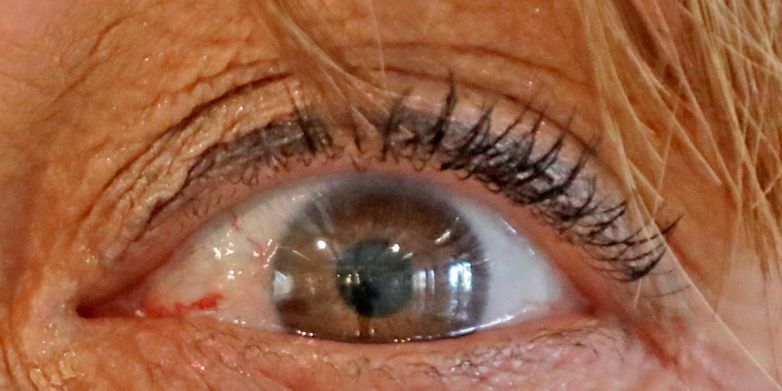 Avances en el diagnóstico precoz del alzhéimer a través de la retina