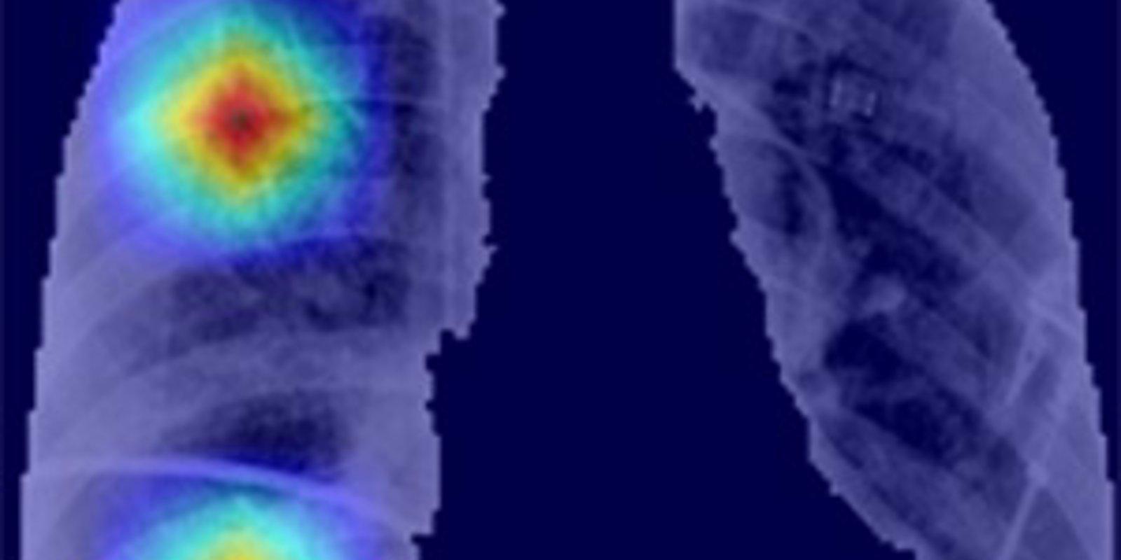 Lanzan 'CoronavIAruX', una herramienta de diagnóstico del Covid-19 basada en inteligencia artificial