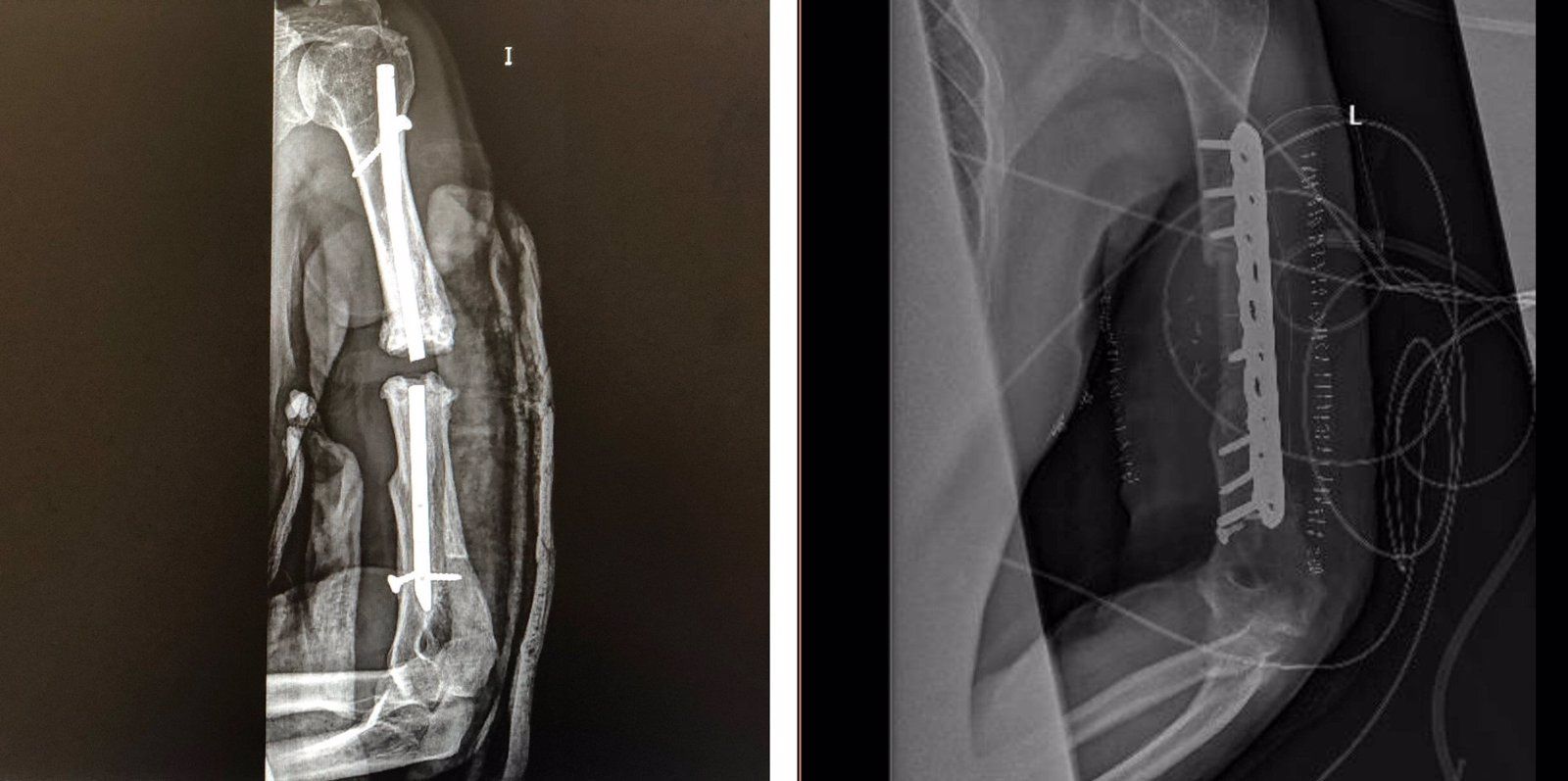 El Hospital de Villalba innova con una intervención basada en la planificación quirúrgica tridimensional