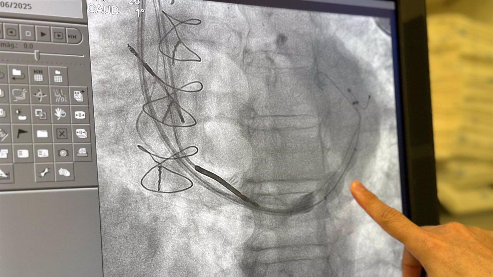 El Hospital de Torrejón implanta con éxito su primer reductor del seno coronario en un paciente con angina refractaria